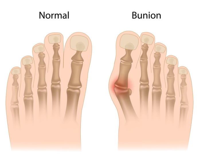 Ouch my bunion! How to walk with bunions